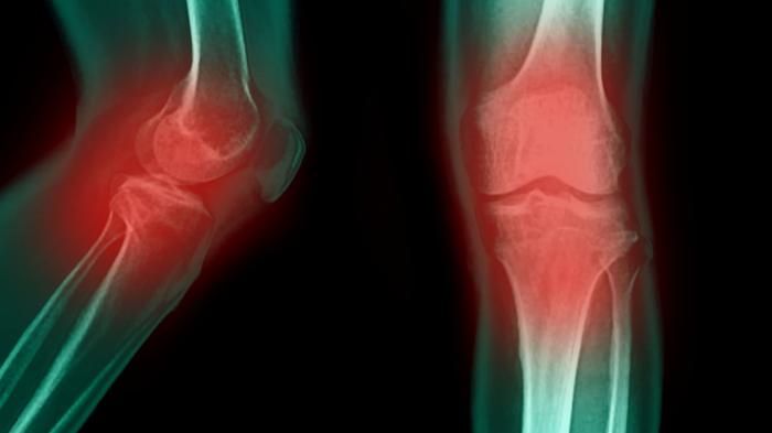 Рентгеновские снимки двух колен, одного сбоку и одного спереди, с красными отметинами, выделяющими суставы.