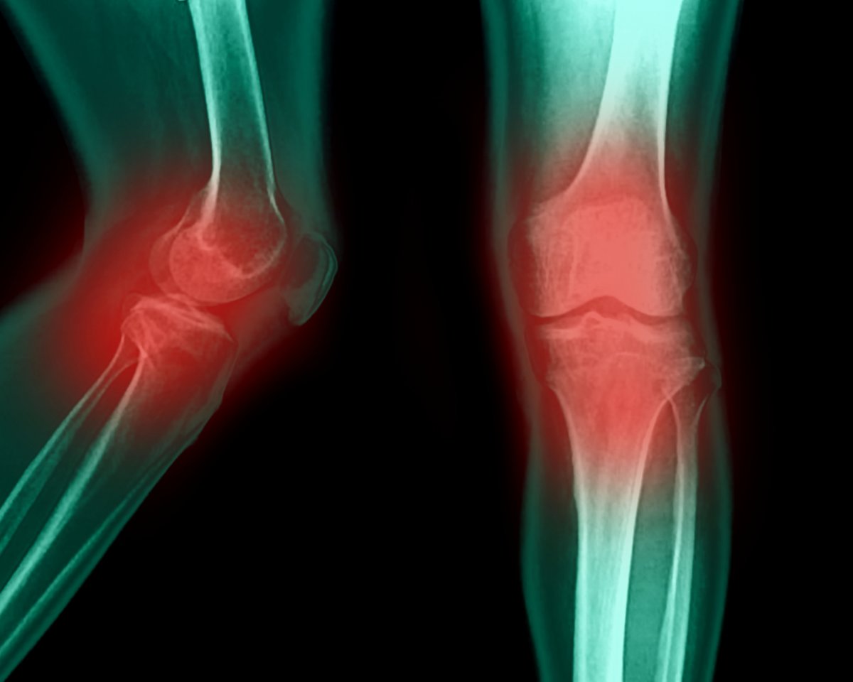 Остеоартрит: исследователи восстанавливают хрящ с помощью протеиновых блокаторов